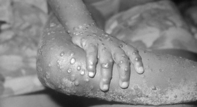 Passa de 300 o número de casos confirmados de varíola do macaco no mundo